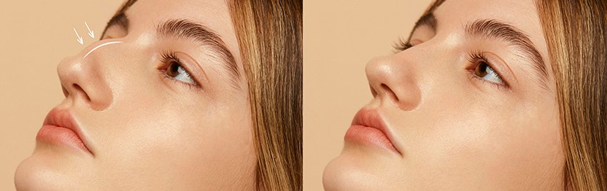 rinoplastia preservadora em sp