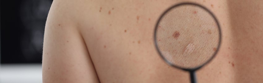 tumores benignos de pele